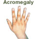 Acromegaly