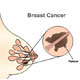 Breast Cancer / Carcinoma of the Breast