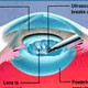 Cataract in Detail