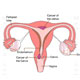 Cervical Cancer