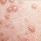 Chickenpox / Varicella