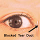 Blocked Tear Duct / Dacryostenosis