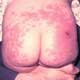 Diaper Rash / Diaper Dermatitis