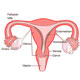 Endometrial Cancer