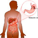 Gastric Cancer / Cancer Of The Stomach