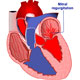 Mitral Valve Regurgitation and Mitral Valve Replacement