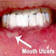 Mouth Ulcers