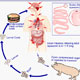 Neurocysticercosis / Cysticercosis of Brain