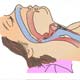 Sleep Disorder: Obstructive Sleep Apnea (OSA)