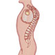 Spondylolisthesis