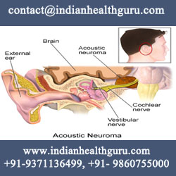 Acoustic Neuroma Surgery treatment in India