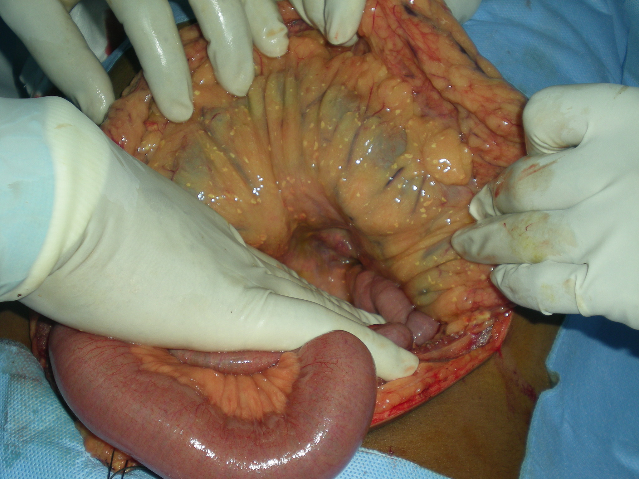 Acute pancreatitis