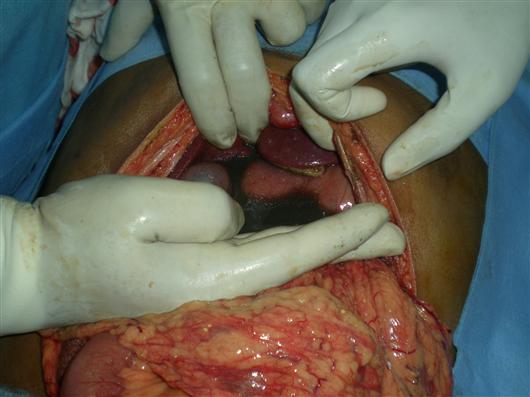 Acute pancreatitis