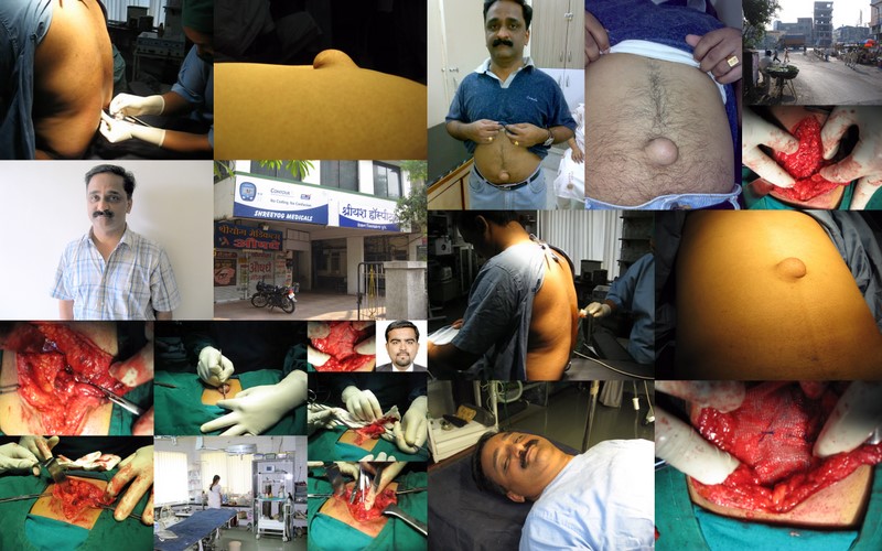 Collage of Umbilical Hernia