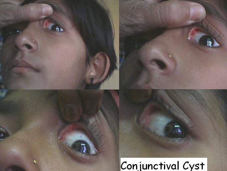 Conjunctival Cyst cured By Homeopathic Medicine