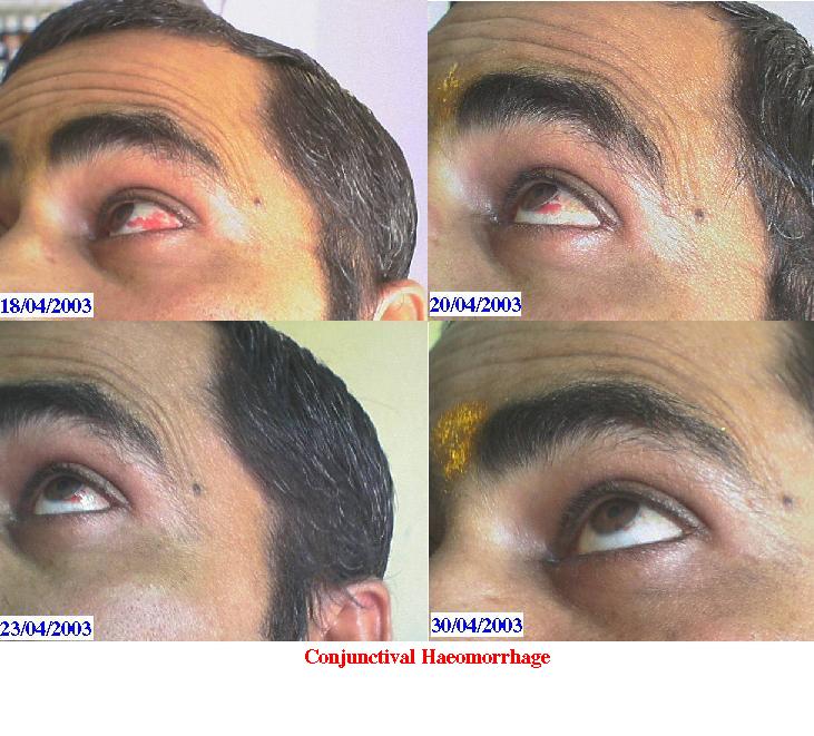 Conjunctival Haemorrage Cured by Homeopathy