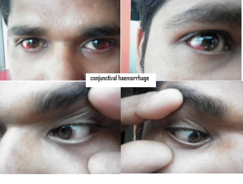 CONJUNCTIVAL HAEMORRHAGE CURED BY HOMOEOPATHY