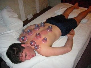 Cupping Therapy