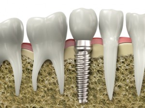 Dental implants