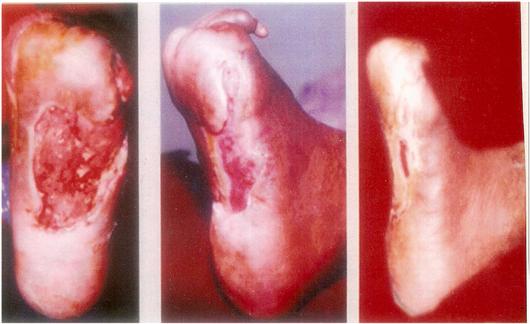 Diabetic foot ulcer treatment