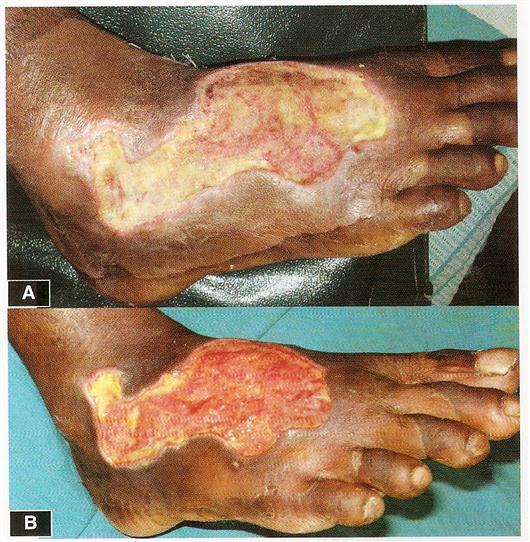 Diabetic foot ulcer treatment