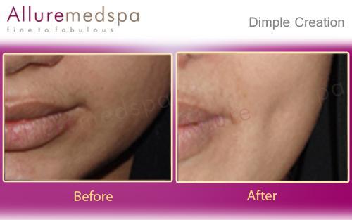 Dimple Creation @ Allure medspa Mumbai India