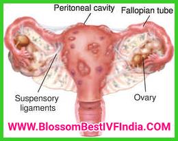 Endometriosis and IVF