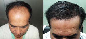 Evolve Hair Treatment IN LUCKNOW