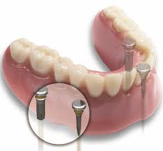 Experience Low Cost Dental Implants Benefit in India