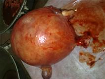 Fibroid uterus