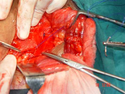 FIG.2 EOA medial leaf sutured to ing.lig.