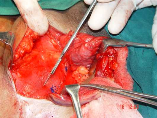 FIG.3 Sutured medial leaf of EOA being incised