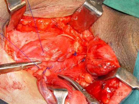 FIG.5 Strip upper border being sutured to int.obl.muscle