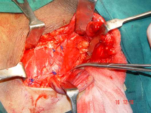 FIG.6 Strip suturing completed