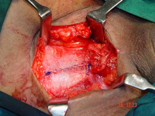 FIG.8 EOA leaves sutured to close ing. canal