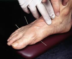 FOOT ACUPUNCTURE