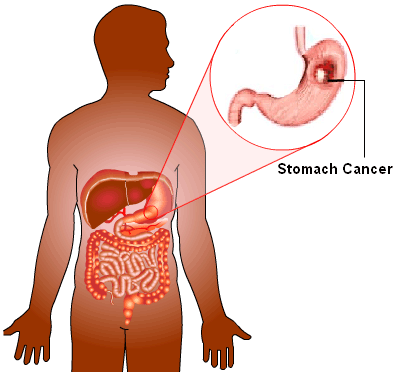 Gastric Cancer / Cancer Of The Stomach