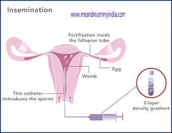 Get pregnant with the help of Artificial Insemination Technique
