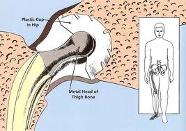 Hip Replacement