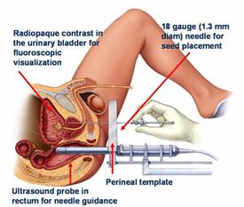 http://www.indianmedguru.com/brachytherapy-India-low-cost-advantages.html