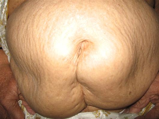 Incisional Hernia