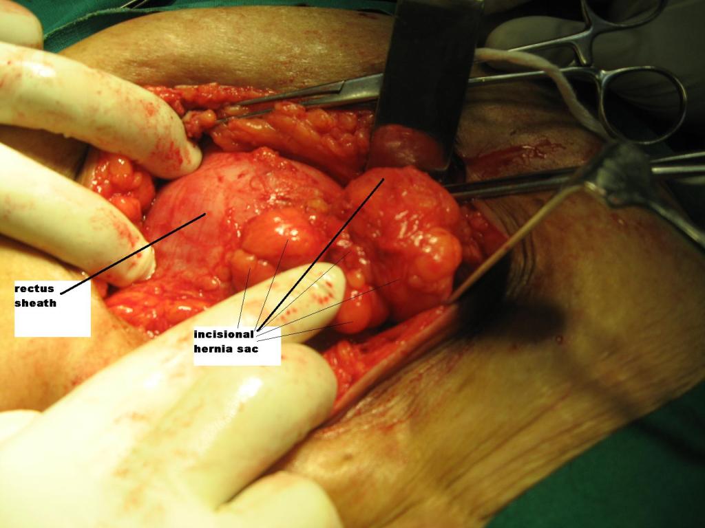 Incisional hernia