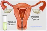 Infertility Treatment - Intrauterine Insemination (IUI)