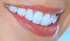 invisible braces, ceramic braces