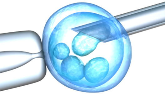 IVF Procedure