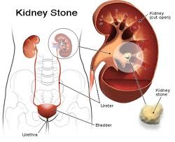 Kidney Stone Surgery Benefits India