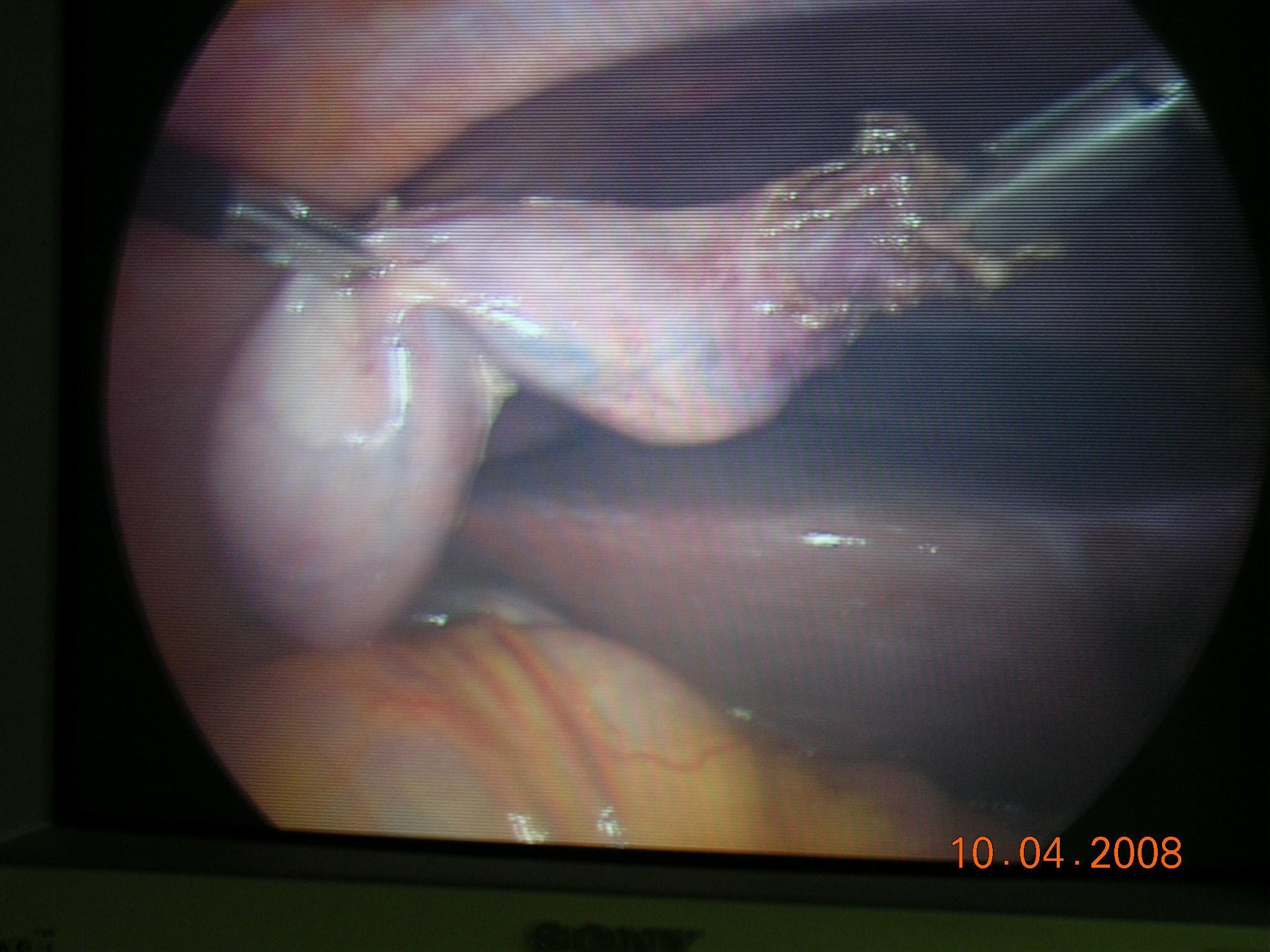 Laparoscopic Cholecystectomy