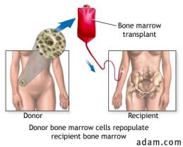 Leukemia Treatment India