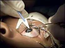 Life Changing Eye Surgery in India