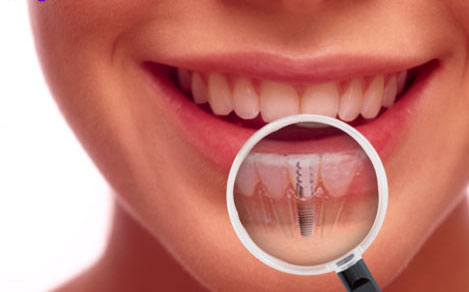 Looking for Affordable Cost of Dental Implants in Costa Rica